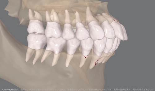 70歳で矯正治療を開始
AIとマウスピース矯正が後押しする「期限を決めた歯科治療」という選択