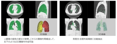 富士フイルムと京都大学　 AI技術を用いた間質性肺炎（*1）の診断支援技術の共同開発に成功