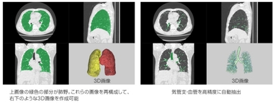 AI技術を用いた間質性肺炎の診断支援技術の共同開発