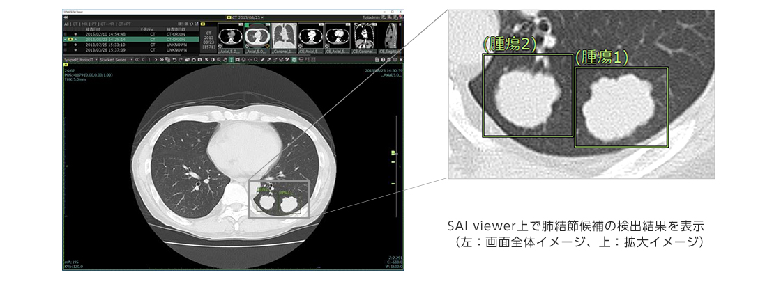 AI技術*1を活用して肺がん診断における胸部CT画像の肺結節*2検出を支援 AIプラットフォーム「SYNAPSE SAI viewer」向けアプリケーション 「肺結節検出機能」新発売