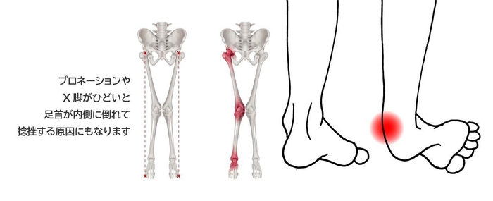 踵のあたりやX脚