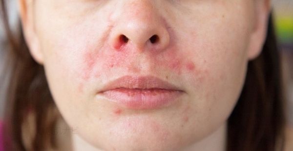 脂漏性皮膚炎 酒さ