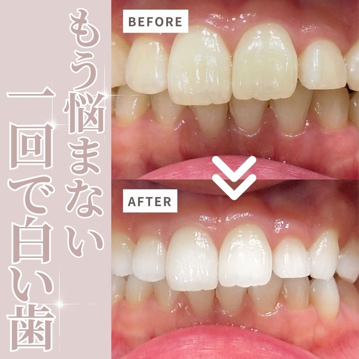 ホワイトニングビフォーアフター画像