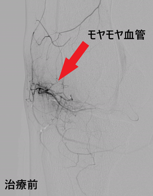 治療前:モヤモヤ血管の画像