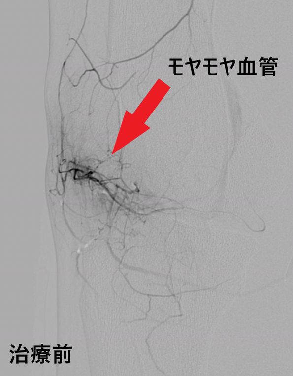治療前:モヤモヤ血管の画像