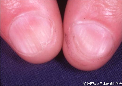 画像引用:公益社団法人日本皮膚科学会