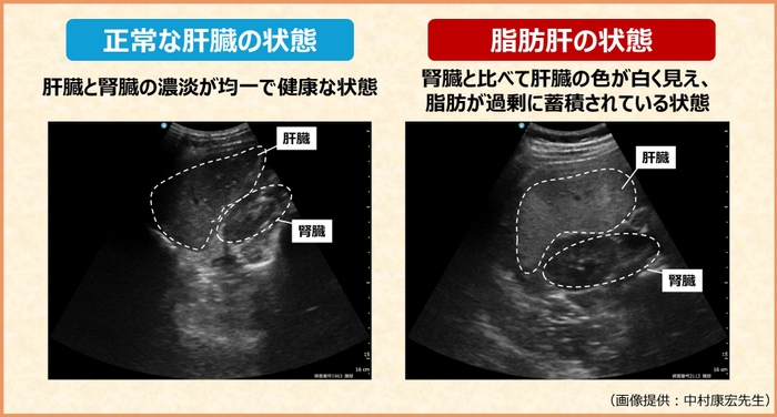 脂肪肝エコー画像