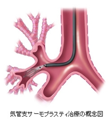 気管支サーモプラスティ治療の概念図