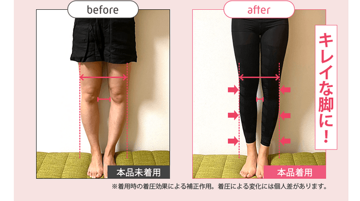 ストレグO脚Before／After