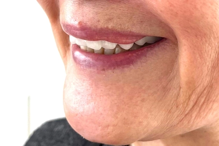 被災時にデジタルデータが命を救う！大規模災害時は義歯無償提供　 全国に広がる「入れ歯銀行」、開始3年で保管数640個