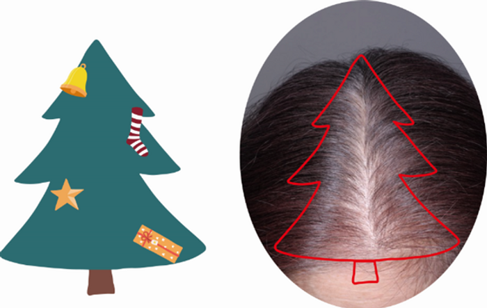 壮年性脱毛症の特異的な進行パターン：クリスマスツリー型