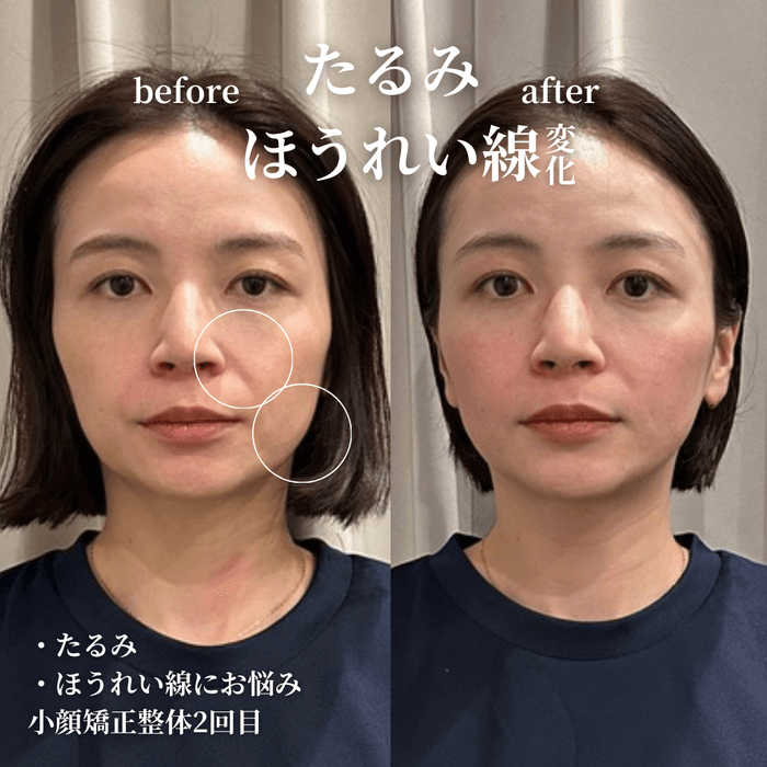 月1回、小顔矯正2回目の効果