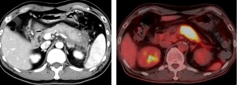 膵臓が大きく腫大している自己免疫性膵炎患者のCTとPET CT画像