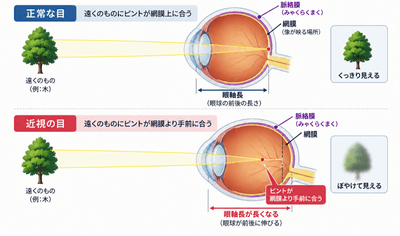正常な目と近視の目
