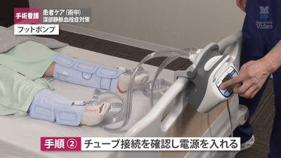 深部静脈血栓症対策