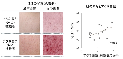 アクネ菌が肌の赤みに関与することを発見