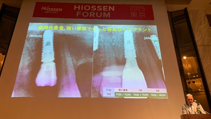図2:赤坂歯科・矯正歯科クリニック 米本 久史先生による『HIOSSENの新たな選択肢:NHインプラントの臨床的利点と適応症例』の講義風景
