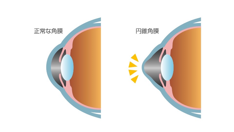 円錐角膜とはどんな病気?