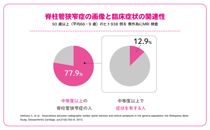 脊柱管がかなり狭くなっていても、約87%の人は、脊柱管狭窄症特有の痛みやしびれなどの症状は出ていない。