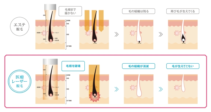 医療脱毛とエステ脱毛