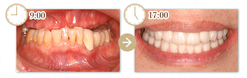 たった1日で抜歯から仮歯装着まで
