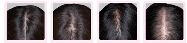 分け目の透け感（壮年性脱毛症）の頭髪写真