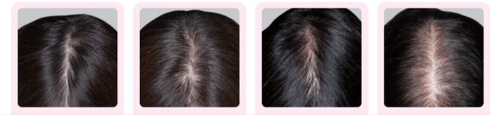 分け目の透け感(壮年性脱毛症)の頭髪写真