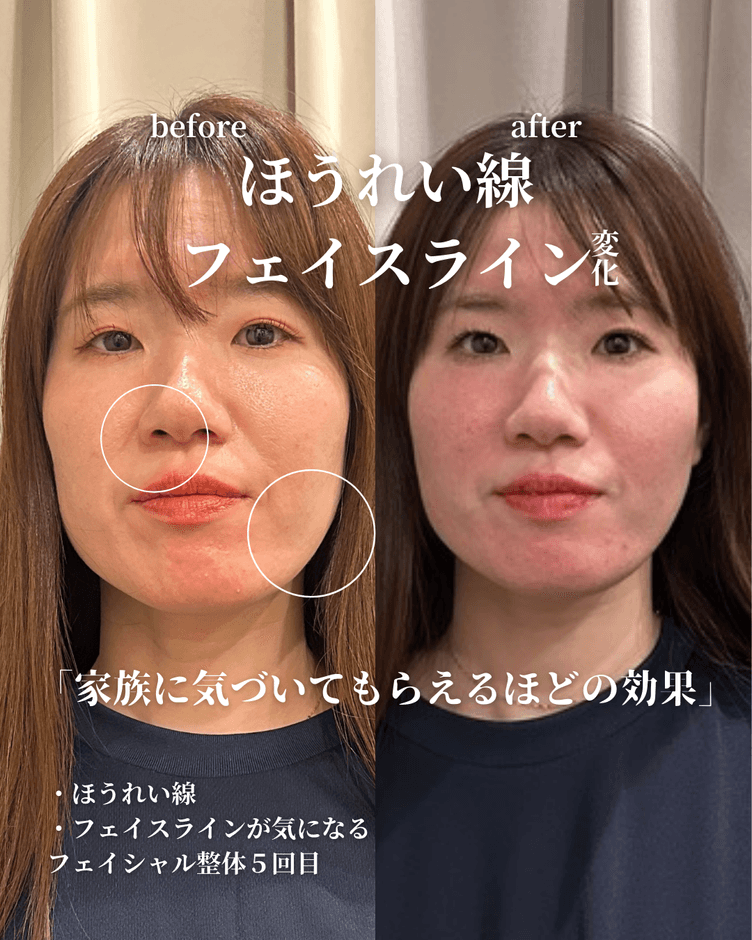 フェアリー式小顔矯正&腸もみ内臓整体5回目