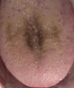 インフル予防のマウスウォッシュ、多用すると“黒い舌”に？！