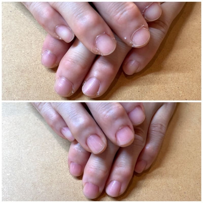 (上)施術前(下)施術後