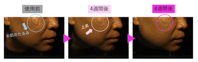 図6 F-ray解析によるたるみの変化の様子