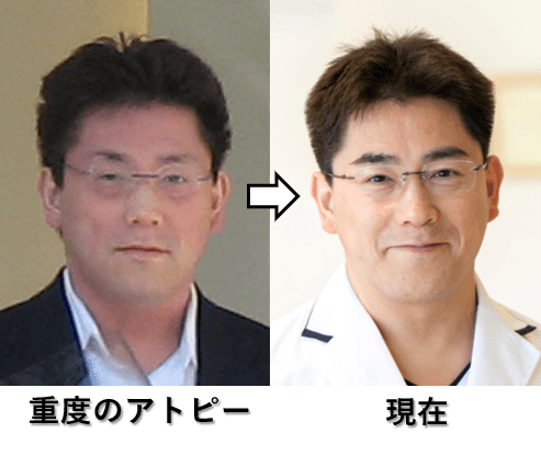 図4:重度のアトピーの時と現在の院長の写真