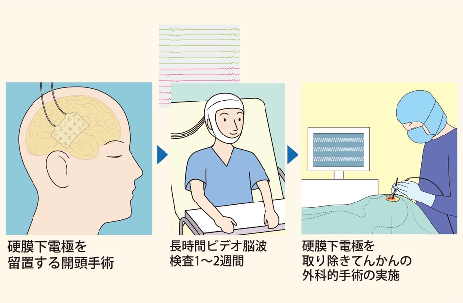 硬膜下電極留置術