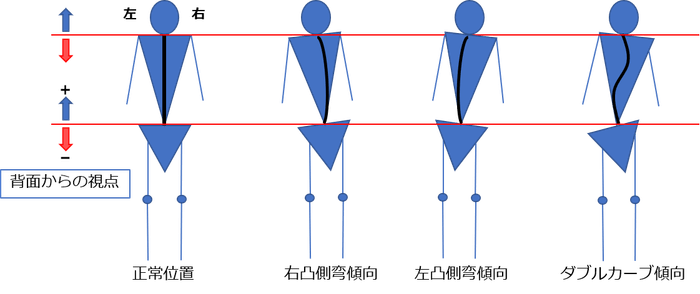 図3 側弯傾向の種別