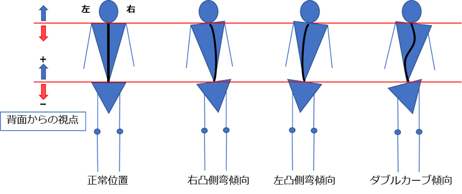 図3 側弯傾向の種別