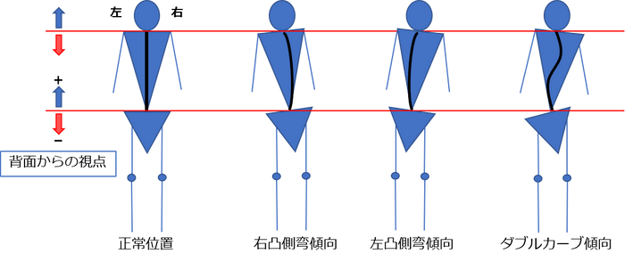 図3 側弯傾向の種別