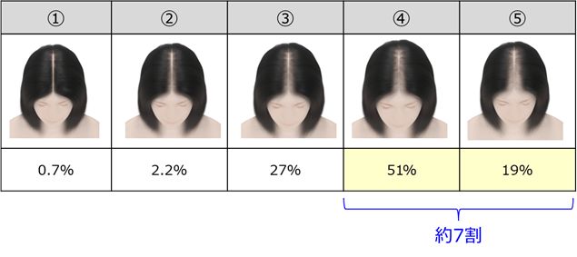 Q2. あなたは、次の頭髪状態のうち、どこからが「壮年性脱毛症」だと思いますか。あてはまるものをひとつお知らせください。