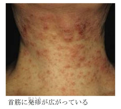 首筋に発疹が広がっている。