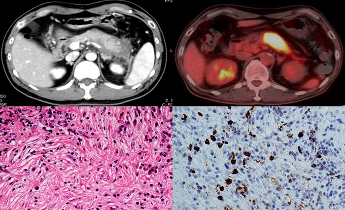 自己免疫性膵炎のCT画像(左上)、自己免疫性膵炎のPET-CT画像(右上)、自己免疫性膵炎の病理組織像(HE染色)(左下)、自己免疫性膵炎の病理組織像(IgG4染色)(右下)