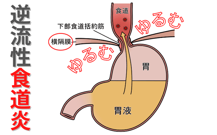 逆流性食道炎のイメージ図