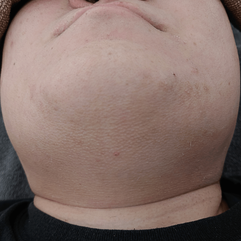 ツルツルのヒゲ画像