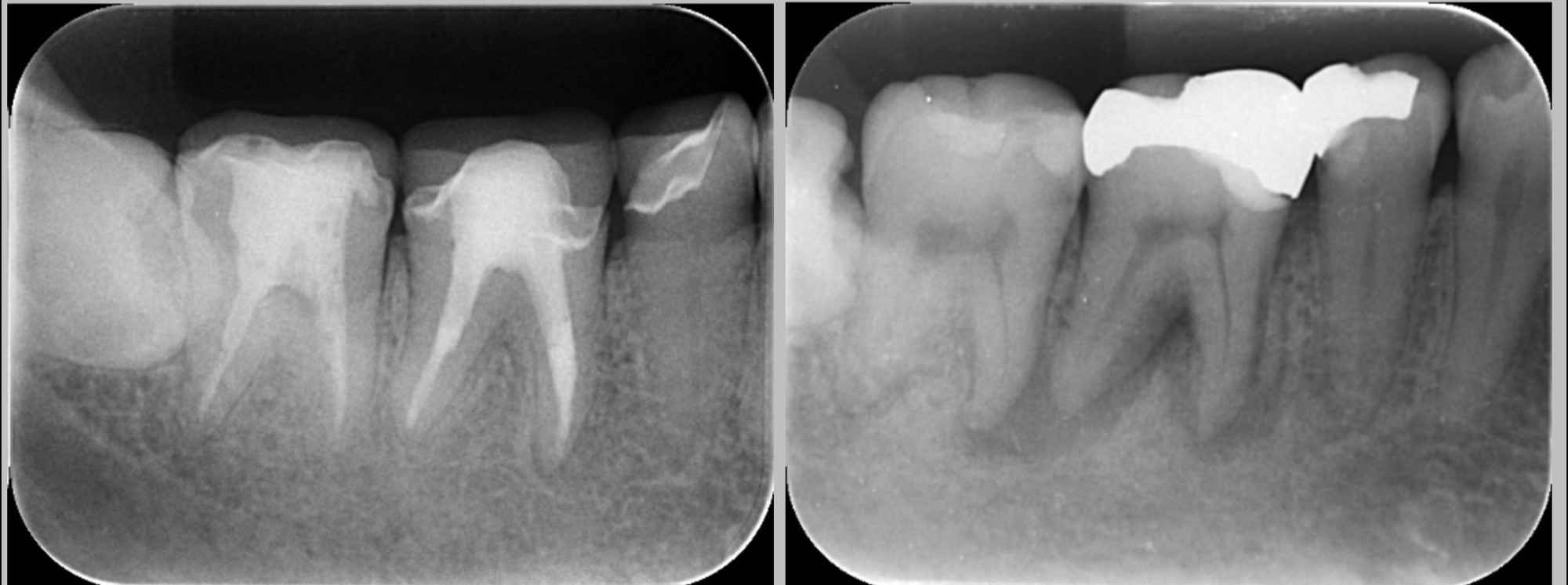 右が2015年ご来院時の治療前のレントゲン写真。黒く影になっているところが病変。左が2025年、一時帰国時の定期健診のレントゲン写真。溶けていた骨が再生されたために、根の先の黒い影が消失している。