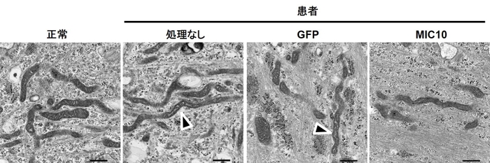 図4　クリステ形成の異常　患者由来線維芽細胞を電子顕微鏡により観察することで、クリステ形成の異常を観察しました（矢印）。また、MIC10を細胞に戻すことで、この異常は回復されました。