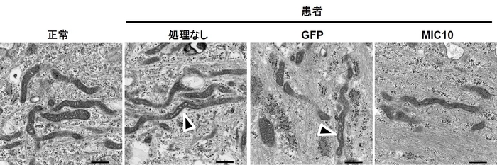 図4 クリステ形成の異常 患者由来線維芽細胞を電子顕微鏡により観察することで、クリステ形成の異常を観察しました(矢印)。また、MIC10を細胞に戻すことで、この異常は回復されました。