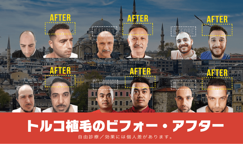 期間限定15万円OFF 「GWトルコ自毛植毛応援キャンペーン」を開催