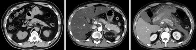 真菌感染が誘導する急性膵炎の重症化メカニズムを解明　死亡率約20％の重症急性膵炎の新たな治療標的が明らかに