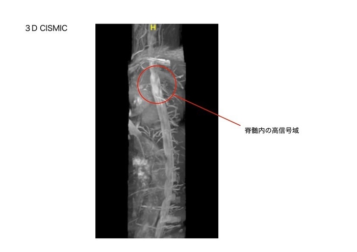 脊髄の3D CISMIC画像。血管の走行と異常信号を示している