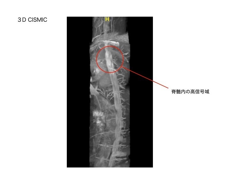 脊髄の3D CISMIC画像。血管の走行と異常信号を示している