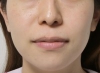 矯正治療後、向かって左側の小鼻が反対に比べると若干小さい感じは残っているが、お顔には左右対称性が見られる