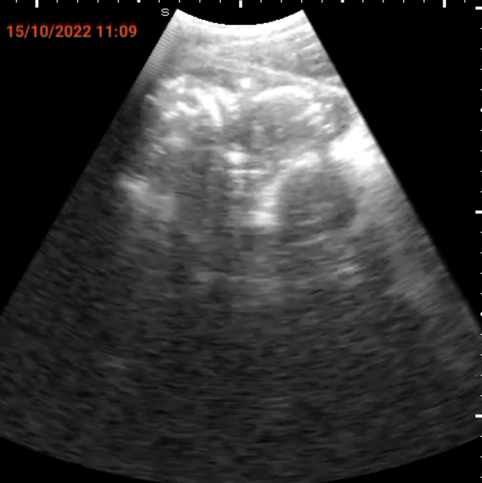 SPAQで発見された子宮外妊娠画像